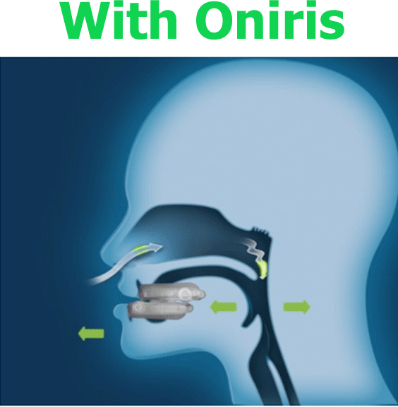 Oniris Mandibular Advancement Device 6