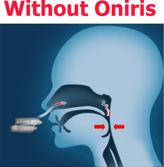 Oniris Mandibular Advancement Device 7